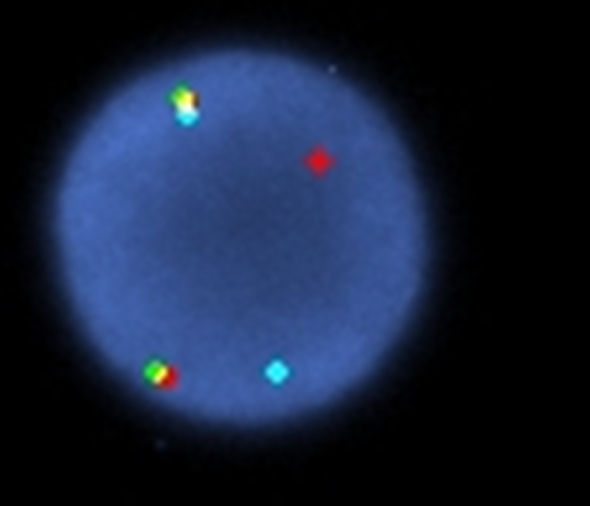 FISH using tricolor probes for SCFD2/FIP1L1, LNX/CHIC2 and PDGFRA demonstrated a population of nuclei with a translocation of the PDGFRA gene from chromosome 4q12. An additional LNX/CHIC2 signal was also observed.